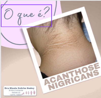 Obesidade Infantil - Acanthose Nigricans
